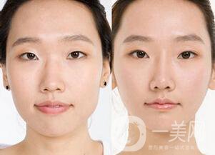硅膠隆鼻手術失敗之后假體取出怎么辦