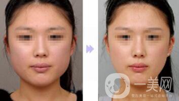 重慶做削骨瘦臉手術多少錢
