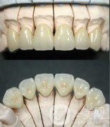 鎳鉻合金烤瓷牙是什么 果怎么樣