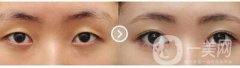 割雙眼皮對眼睛有什么壞處