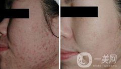 彩光祛痘原理原理是什么？果如何