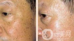 老年斑是如何產(chǎn)生的？怎么去老年斑