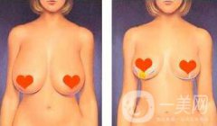 北京乳房下垂矯正手術(shù)多少錢