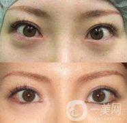 眼臉下至老了會怎么樣?會變下垂嗎?