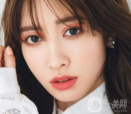 焊接雙眼皮是什么？多久能好？
