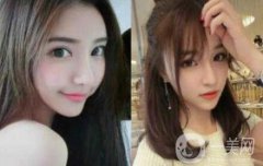 上海整形醫(yī)院做磨骨手術(shù)多少錢