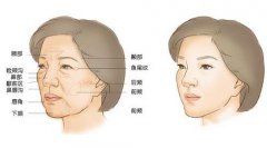 自體脂肪填充后*忌諱什么