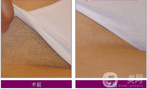廈門(mén)女性比基尼部位脫毛價(jià)格一般是多少