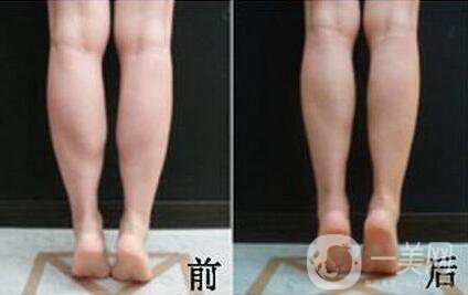 *注射瘦小腿*果怎么樣？