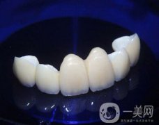 金鈀合金烤瓷牙價格多少錢？