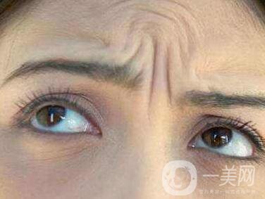 抬頭紋能消除嗎？有哪些方法？
