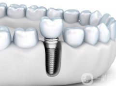 上海做種植牙介紹?