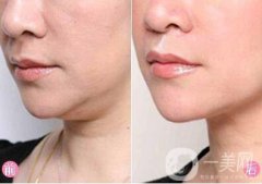 去掉雙下巴多少錢？