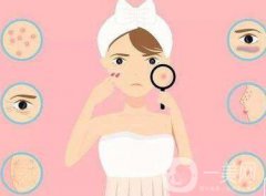 怎么去痘印啊 激光祛痘印果介紹