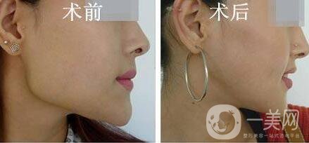 磨骨多少錢？磨骨價(jià)格盤點(diǎn)！