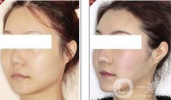 改臉型需要多少錢？