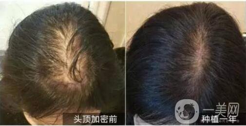 北京做植發(fā)手術哪里*果好？