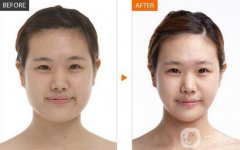 北京顴骨手術要多少錢？