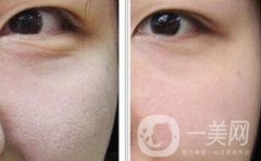 光子嫩膚介紹?成都光子嫩膚醫(yī)院介紹