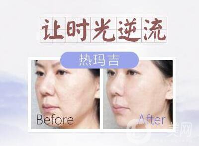 塑美極的副作用有哪些？