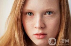 黃褐斑能用激光去除嗎？