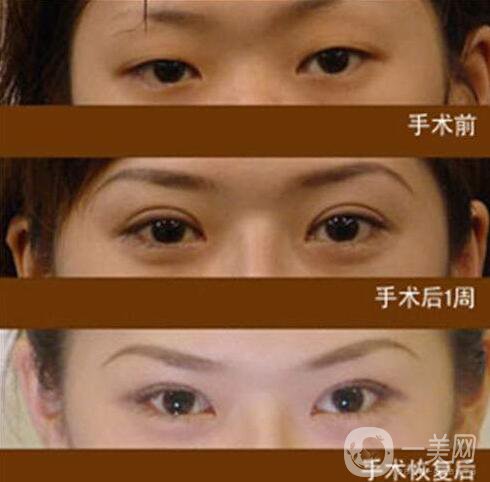 北京,割雙眼皮