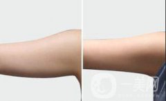 廣東手臂吸脂需要多少錢?