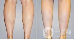 南京光纖溶脂瘦小腿價格是多少