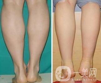 南京光纖溶脂瘦小腿價(jià)格是多少