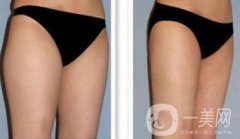 吸脂*嗎？吸脂手術(shù)有風(fēng)險(xiǎn)嗎