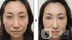 小切口面部提升果怎么樣？會(huì)不會(huì)留疤
