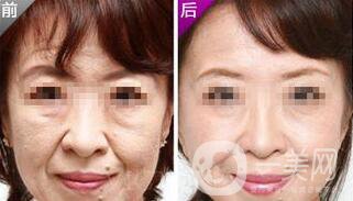 小切口面部提升*果怎么樣？會(huì)不會(huì)留疤