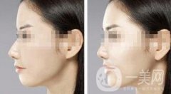 墊下巴用什么材料好？墊下巴改良臉型果