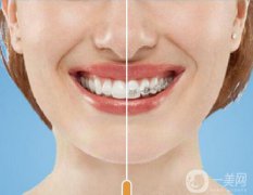 t4a可以矯正牙齒嗎?t4a可以矯正牙齒怎么樣?