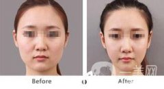 北京哪里吸脂好？吸脂手術(shù)會反彈嗎