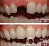 種植牙有什么優(yōu)點(diǎn)？北京種植牙介紹?