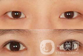韓式三點(diǎn)法割雙眼皮手術(shù)的價格一般是多少