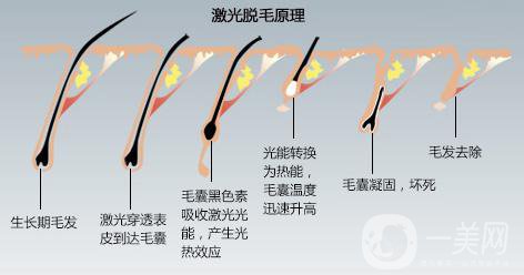 北京激光脫毛費用介紹 價格詳情