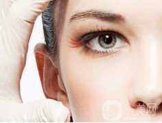 深圳魚尾紋打玻尿酸要多少錢?