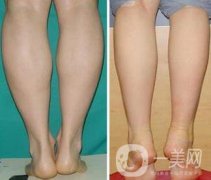 射頻瘦小腿保持多久?纖細雙腿不是夢美