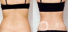 后背吸脂后多久消腫？吸脂術(shù)后如何護(hù)理