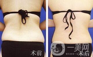 后背吸脂后多久消腫？吸脂術(shù)后如何護理