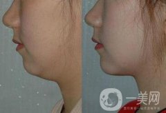 雙下巴吸脂注意事項介紹 雙下巴吸脂多少錢