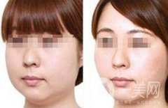 光纖溶脂去雙下巴注意事項詳解