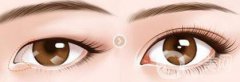 開眼角幾天恢復(fù)？開眼角手術(shù)費(fèi)用介紹