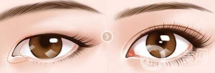 開(kāi)眼角幾天恢復(fù)？開(kāi)眼角手術(shù)費(fèi)用介紹