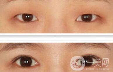 開(kāi)眼角幾天恢復(fù)？開(kāi)眼角手術(shù)費(fèi)用介紹