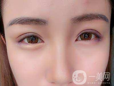 全切雙眼皮恢復(fù)過程一般是怎樣的 要注意些什么