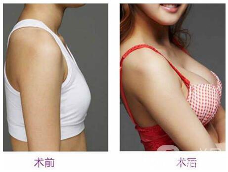 隆胸恢復期多久正常 隆胸恢復時間要多久 2