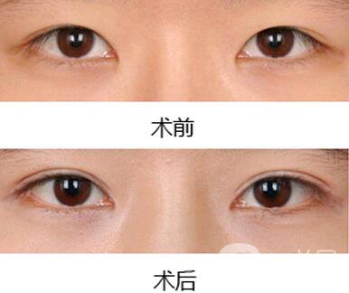 雙眼皮增生了怎么處理？雙眼皮修復(fù)價格多少